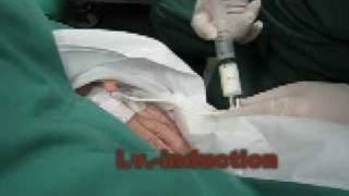 Ambu AuraOnce  Laryngeal Mask  Insertion in real patient [upl. by Nit383]