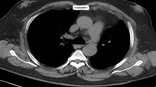 Cross sectional and imaging anatomy of the thorax [upl. by Lrac3]