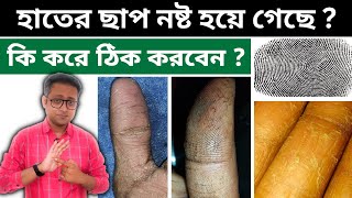 Fingerprint আসছে না  হাতের ছাল উঠছে  কি করবেন  Bengali  Dr Supratim Saha [upl. by Nichols]