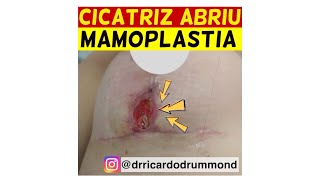 CICATRIZ DA MAMOPLASTIA ABRIU O QUE FAZER  Dr Ricardo Drummond [upl. by Nellac]