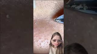 Blackheads Removal  Acne Treatment and Very Satisfying Satisfying Pimple pop blackheads [upl. by Ergener268]