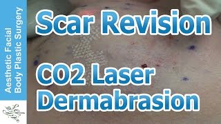 Laser Scar Revision With CO2 Laser Part 02 by Dr Philip Young Bellevue Seattle Washington [upl. by Adiaz]