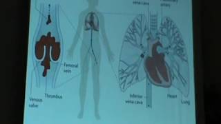 Pulmonary Embolism part one [upl. by Acirfa]