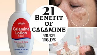 CALAMINE lotion  Lacto calamine lotion uses in detail side effects [upl. by Ulrike]