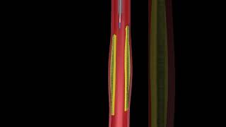 Animated angioplasty Explained in 3D  Watch the Procedure [upl. by Ahsemed]