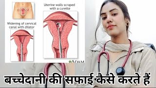 D and C after miscarriage बच्चेदानी की सफाई कैसे करते हैं D and C dilatation and curettage DampC [upl. by Eigriv]