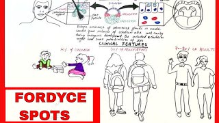 Fordyce Spots  Pathophysiology Clinical Features amp Treatment [upl. by Jarl]