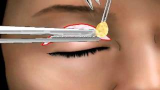 BLEFAROPLASTIA SUPERIOR DR FERNANDO PEDROZA [upl. by Nirot]