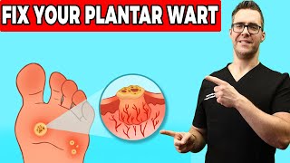 Plantar Warts Removal at Home Treatment Foot amp Toe Wart Remedies [upl. by Razid]