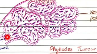 Fibroadenoma And Phyllodes Tumor  Pathology [upl. by Saylor]