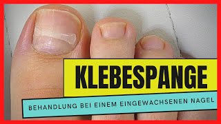 EINGEWACHSENEN NAGEL mit einer KLEBESPANGE behandeln  Podostripe Klebespange [upl. by Ume]