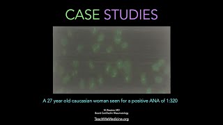 Case Studies A 27 year old caucasian woman seen for a positive ANA test of 1320 [upl. by Hsivat]