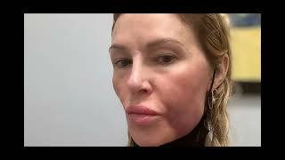 Brandi Glanville blames Bravo for being miserable and depressed as she shares shocking swollen fac [upl. by Orlanta368]