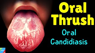 Oral Thrush  Oral Candidiasis – Symptoms Causes Diagnosis Treatment Complications [upl. by Allemahs]