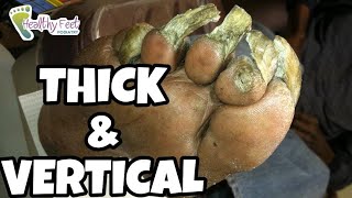 CUTTING SEVERE THICK NAILS HOW TO CUT THICK TOENAILS FUNGUS IN TOENAILS FUNGAL NAIL CURE [upl. by Laerdna372]