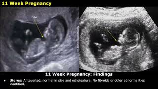 Obstetric Ultrasound Reporting  How To Write USG Reports  Pregnancy Sonography  TIFFA Scan [upl. by Nigle]