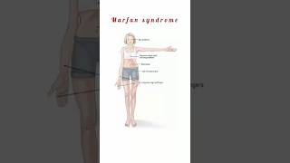 Marfan Syndrome kattrucate medicalreels marfansyndrome kyphosis scoliosis tall stature [upl. by Atteynot]