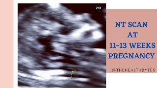 NT scan 11 to 13 weeks scan  explained Tamil version [upl. by Reider]