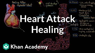 Healing after a heart attack myocardial infarction  NCLEXRN  Khan Academy [upl. by Yrem]