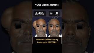 HUGE Lipoma Removal at GSR [upl. by Jennilee]