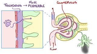 Diabetic Nephropathy  Osmosis [upl. by Elodia973]