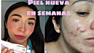 Tretinoina antes y despues manchas y acne● [upl. by Cecilla]