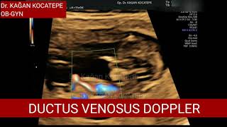 Ductus venosus Doppler of the fetus Its role in detection of Downs syndrome and other trisomies [upl. by Ress]