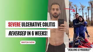 Severe Ulcerative Colitis Reversed in 6 Weeks [upl. by Alberic]