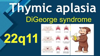 Thymic aplasia  DiGeorge Syndrome  USMLE Step 1 Immunology [upl. by Solegnave468]