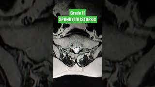 Grade II Anterior Spondylolisthesis of L5 over S1 vertebra viral youtubeshorts mri shortsfeed [upl. by Ressay]