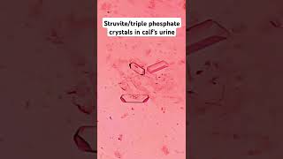 urinary crystalsstruvitetriple phosphateMAP [upl. by Nahtanaoj]