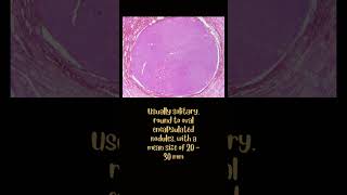 Follicular adenoma [upl. by Dnalsor]