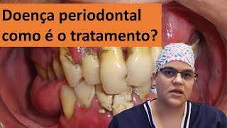 Doença periodontal tem cura qual o tratamento Dra Bianca Rosa  Clínica Bianca Rosa [upl. by Llerahc]