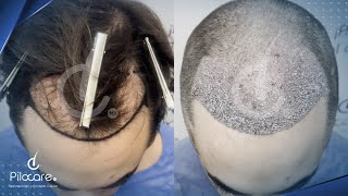 Procedimiento  Regeneración frontal hairline y entradas  CDMX [upl. by Bierman]