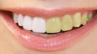 Photoshop Tutorial  How to Make Whitening Teeth [upl. by Mandel133]