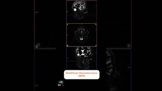 MRI SIALOGRAPHY [upl. by Attennod848]