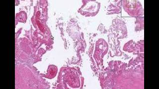 Histopathology GallbladderAcute cholecystitis [upl. by Cardew449]