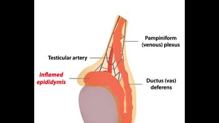 Epididymitis [upl. by Li]