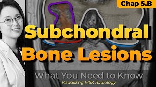 Chapter 5 B⎜Subchondral bone lesions ⎜Knee MRI⎜Visualizing MSK Radiology⎜Refer to timeline [upl. by Nosauq]