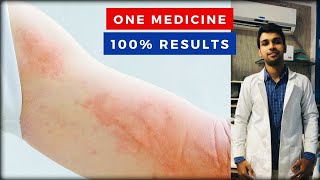 Urticaria Skin Rashes 100 Results From The First Week [upl. by Cathryn]