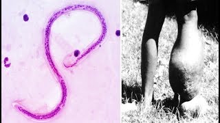 You Wont Believe What This Tiny Worm Can Do To The Human Body [upl. by Carena]