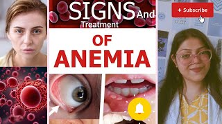 sign  symptoms and treatment of ANEMIA  khoon ki kami ke lakshan aur ise kaise dur kare anemia [upl. by Eoz]