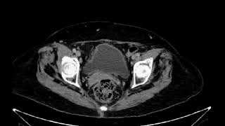 Px con adenocarcinoma de pulmón metastásico se solicita estudio para valorar de respuesta a tx [upl. by Tolliver685]