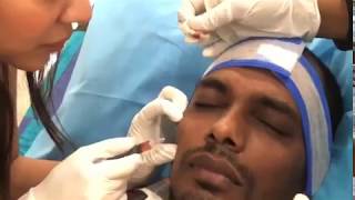 Under Eye PRF Injections By DR Nidhi Gupta [upl. by Abih579]