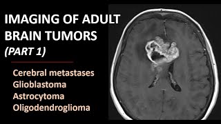 Imaging of brain tumors part 1 metastases glioblastoma and beyond [upl. by Seligman]