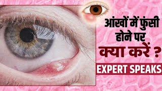 Eye Infection Prevention बरसात के मौसम में आंखों में होती है ये दर्दनाक समस्या जानें इलाज [upl. by Esinyt589]