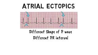 ATRIAL ECTOPICS [upl. by Atsejam]