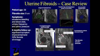 Uterine Fibroid Treatment Options [upl. by Linn]