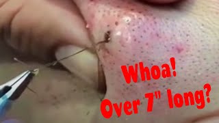 Hairy Situations Ingrown hairs infected follicles pops  more [upl. by Gen]