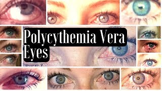 MPN Polycythemia Vera Blood Shot Red Eye Manifestations [upl. by Houser]